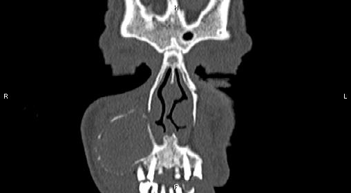 File:Central giant cell granuloma (Radiopaedia 83346-97761 Coronal bone window 4).jpg