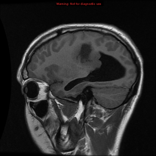 File:Central neurocytoma (Radiopaedia 13188-13206 Sagittal T1 2).jpg