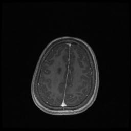 Central neurocytoma (Radiopaedia 30220-30842 Axial T1 C+ 121).jpg