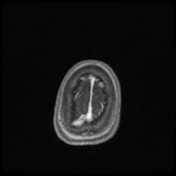 Central neurocytoma (Radiopaedia 30220-30842 Axial T1 C+ 141).jpg