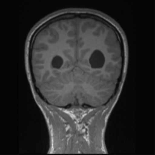 Central neurocytoma (Radiopaedia 37664-39557 Coronal T1 24).png