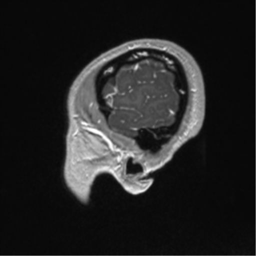 Central neurocytoma (Radiopaedia 37664-39557 Sagittal T1 C+ 12).png