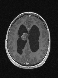Central neurocytoma (Radiopaedia 56690-63469 Axial T1 C+ 116).jpg