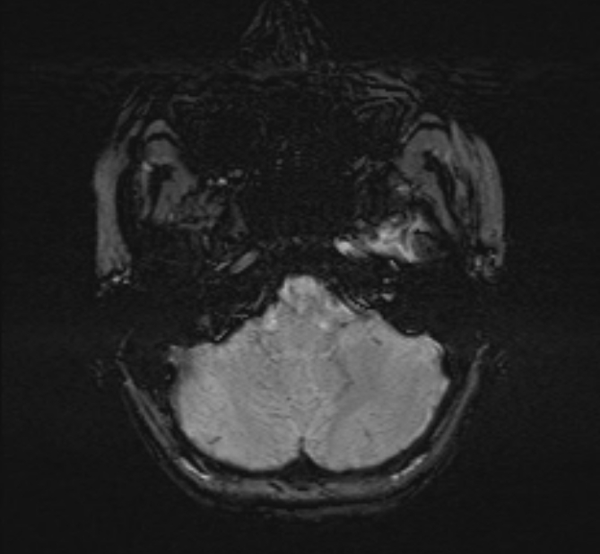 Central neurocytoma (Radiopaedia 70263-80336 Axial SWI 8).jpg
