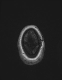 Central neurocytoma (Radiopaedia 84497-99872 Axial T1 177).jpg