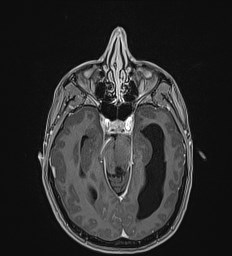 Central neurocytoma (Radiopaedia 84497-99872 Axial T1 C+ 58).jpg