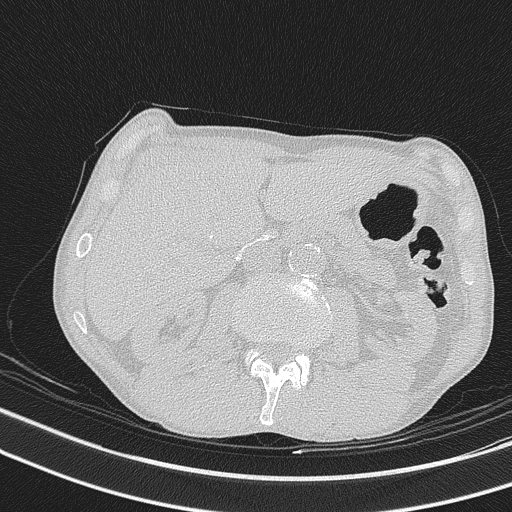 Central venous catheter tip extravasation (Radiopaedia 82828-97113 Axial lung window 92).jpg