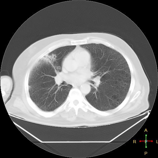 File:Centrilobular emphysema - with superimposed infection (Radiopaedia 24389-24683 lung window 15).jpg