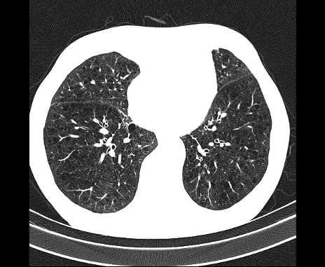 Centrilobular pulmonary emphysema (Radiopaedia 62468-70718 Axial lung window 53).jpg