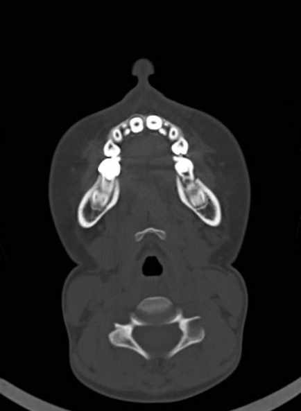 File:Cerebellar abscess (Radiopaedia 73727-84527 Axial bone window 3).jpg