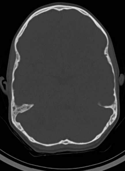 Cerebellar abscess (Radiopaedia 73727-84527 Axial bone window 30).jpg