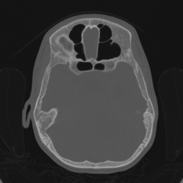 Cerebellar abscess secondary to mastoiditis (Radiopaedia 26284-26413 Axial bone window 77).jpg