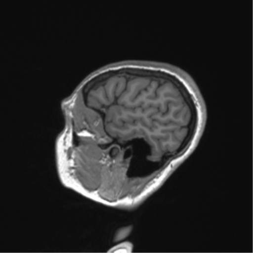 Cerebellar agenesis with hypoplastic pons (pontocerebellar hypoplasia) (Radiopaedia 57224-64138 Sagittal T1 16).png