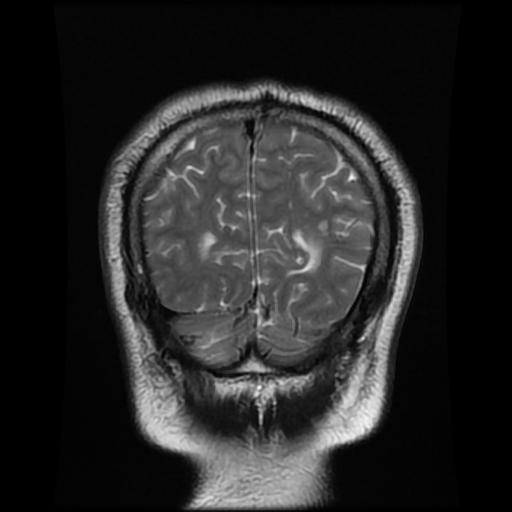 File:Cerebellar hemangioblastoma (Radiopaedia 88055-104622 Coronal T2 16).jpg
