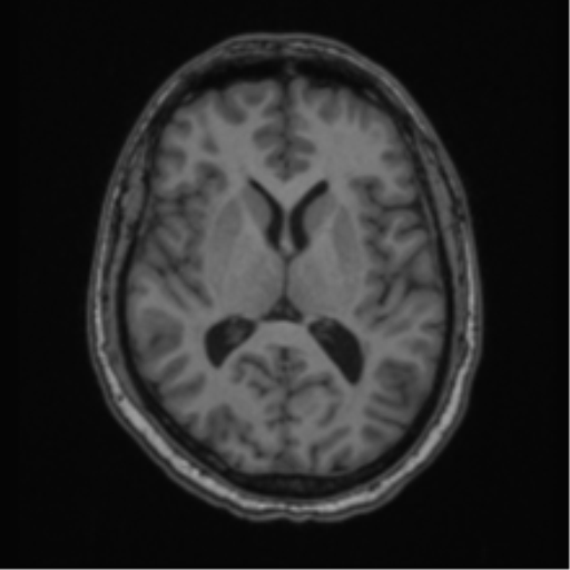 File:Cerebellar hemangioblastomas and pituitary adenoma (Radiopaedia 85490-101176 Axial T1 40).png