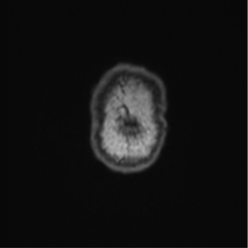 Cerebellar hemangioblastomas and pituitary adenoma (Radiopaedia 85490-101176 Coronal T1 4).png