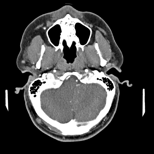 Cerebellar infarct due to vertebral artery dissection with posterior fossa decompression (Radiopaedia 82779-97029 C 34).png