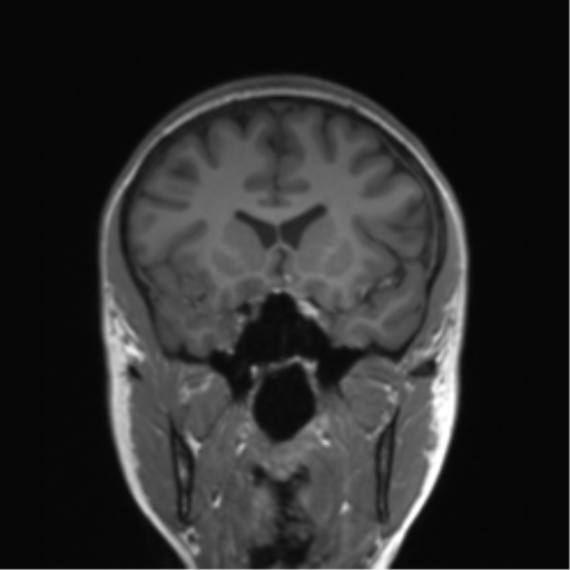 Cerebellar metastasis - lung tumor (Radiopaedia 69317-79150 A 40).png