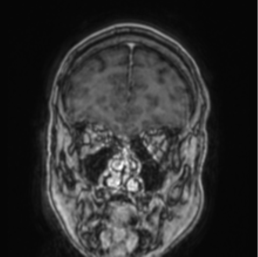 Cerebellar metastasis from lung adenocarcinoma (Radiopaedia 86690-102829 Coronal T1 C+ 78).png