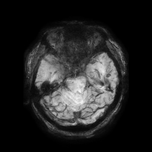 Cerebellar metastasis of pulmonary adenocarcinoma, cavernous venous malformation, and developmental venous anomaly (Radiopaedia 85827-101661 Axial SWI 47).jpg