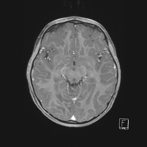 Cerebellar stroke (Radiopaedia 32202-33150 Axial T1 C+ 36).png