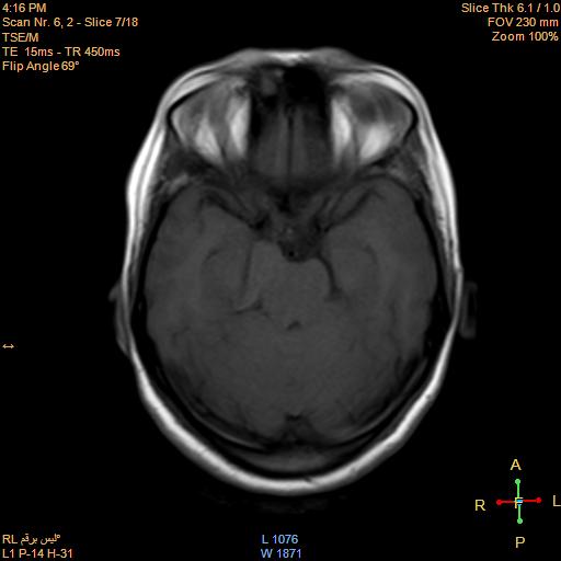 File:Cerebellopontine angle meningioma (Radiopaedia 22488-22525 Axial T1 6).jpg