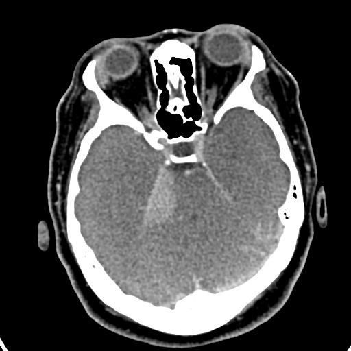 Cerebellopontine angle meningioma (Radiopaedia 35181-36714 A 12).jpg