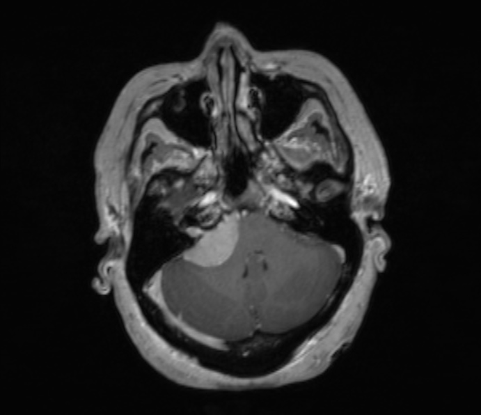 Cerebellopontine angle meningioma (Radiopaedia 35181-36715 Axial T1 C+ 42).jpg
