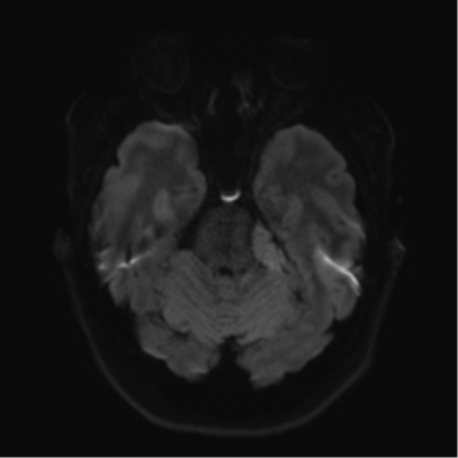 Cerebellopontine angle meningioma (Radiopaedia 48434-53348 Axial DWI 48).png