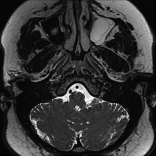 Cerebellopontine angle meningioma (Radiopaedia 48434-53348 Axial T2 Space 30).png