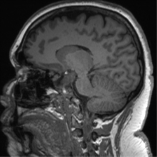 Cerebellopontine angle meningioma (Radiopaedia 48434-53348 Sagittal T1 53).png