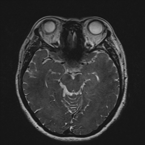 Cerebellopontine angle meningioma (Radiopaedia 53561-59591 Axial 3D volume T2 101).jpg