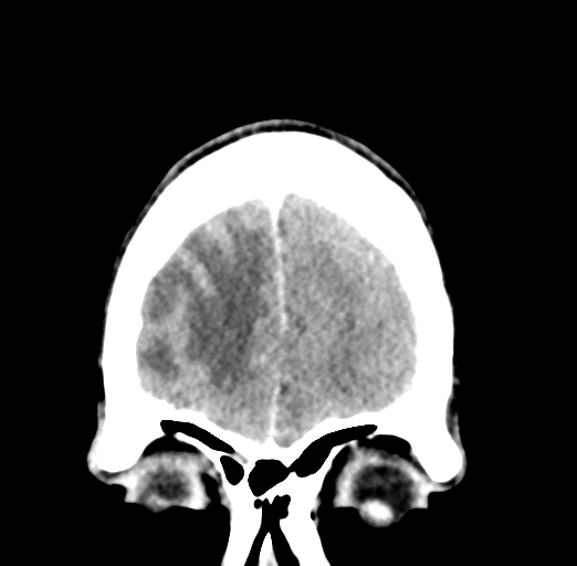 Cerebral abscess (Radiopaedia 60342-68008 Coronal C+ delayed 10).png