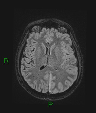 Cerebral abscess and subdural empyema (Radiopaedia 84436-99779 Axial FLAIR 39).jpg