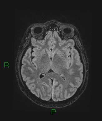 File:Cerebral abscess and subdural empyema (Radiopaedia 84436-99779 Axial FLAIR 43).jpg