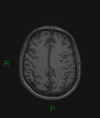 File:Cerebral abscess and subdural empyema (Radiopaedia 84436-99779 Axial T1 29).jpg