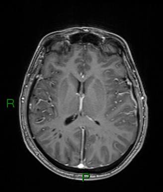 Cerebral abscess and subdural empyema (Radiopaedia 84436-99779 Axial T1 C+ 40).jpg