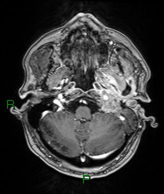 Cerebral abscess and subdural empyema (Radiopaedia 84436-99779 Axial T1 C+ 71).jpg