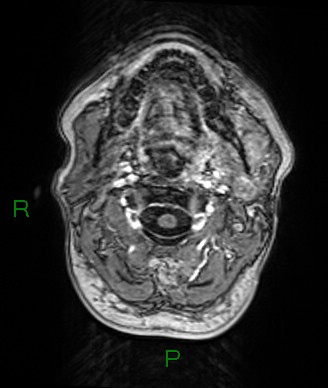 Cerebral abscess and subdural empyema (Radiopaedia 84436-99779 Axial T1 C+ 87).jpg