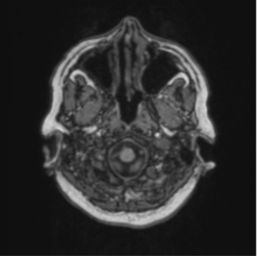 Cerebral abscess from pulmonary arteriovenous malformation (Radiopaedia 86275-102291 Axial T1 10).png