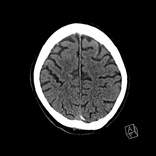 Cerebral abscess with ventriculitis (Radiopaedia 78965-91876 Axial non-contrast 38).jpg