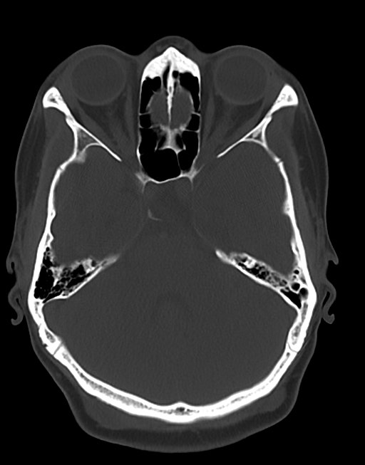 Cerebral abscesses (Radiopaedia 70458-80568 Axial bone window 21).jpg