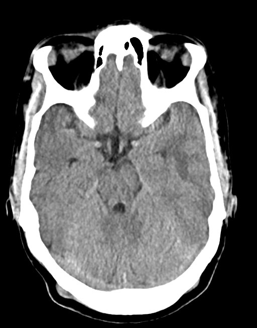 Cerebral abscesses (Radiopaedia 70458-80568 Axial non-contrast 24).jpg