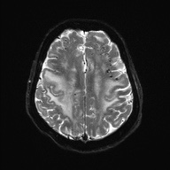 Cerebral amyloid angiopathy-related inflammation (Radiopaedia 74836-85849 Axial DWI 21).jpg