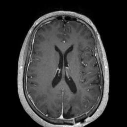 Cerebral amyloid angiopathy (Radiopaedia 29129-29518 Axial T1 C+ 89).jpg