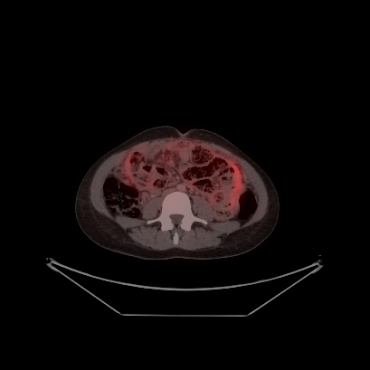 Cerebral and abdominal tuberculosis (Radiopaedia 90499-107853 C 184).jpg