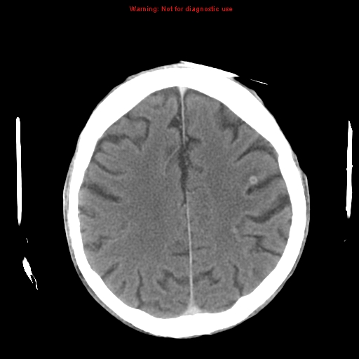 File:Cerebral and orbital tuberculomas (Radiopaedia 13308-13310 B 21).jpg