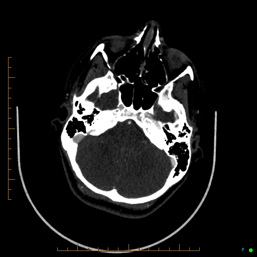 Cerebral arteriovenous malformation (AVM) (Radiopaedia 78162-90706 Axial CTA 78).jpg