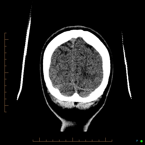 Cerebral arteriovenous malformation (AVM) (Radiopaedia 78162-90706 Coronal non-contrast 88).jpg