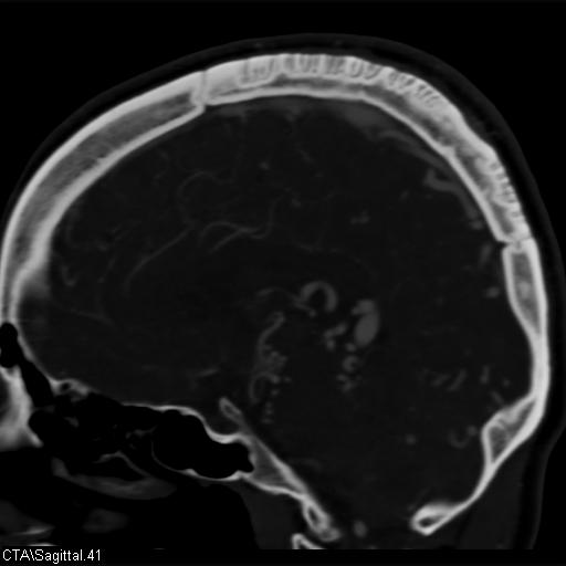 File:Cerebral arteriovenous malformation (Radiopaedia 28518-28759 D 38).jpg